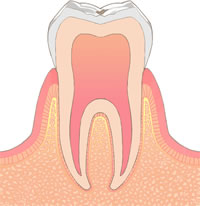 むし歯C0
