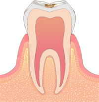 むし歯C1