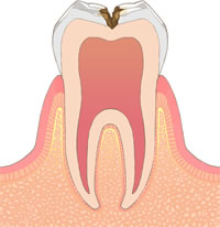 むし歯C2