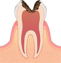 むし歯C3