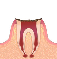 むし歯C4