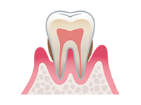 歯周病