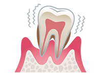 歯周病