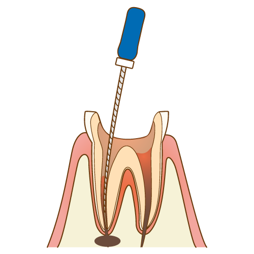 根管治療